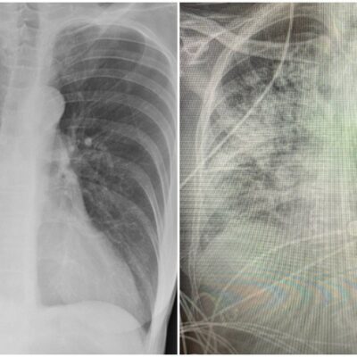 pulmones-de-pacientes-con-covid-19-quedan-mas-danados-que-los-de-fumadores
