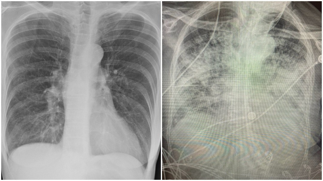 pulmones-de-pacientes-con-covid-19-quedan-mas-danados-que-los-de-fumadores